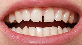An individual smiling to expose a gap between their upper front two teeth
