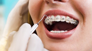 An up-close view of a patient wearing traditional braces and having their fixtures checked by an orthodontist