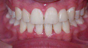 Aligned teeth