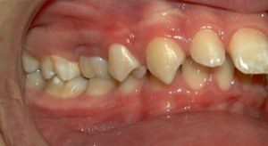 Impacted tooth and uneven spacing