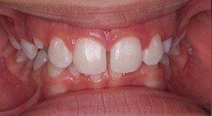 Reduced overbite during treatment