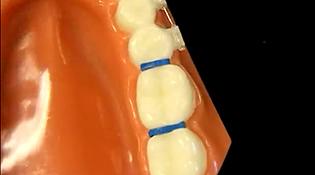 Model of smile with spacers for braces