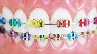 colorful metal braces in McMurray