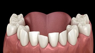 a 3 D example of crowded teeth