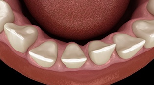 a 3 D illustration of gaps between teeth