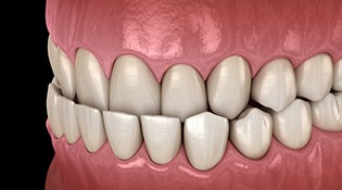 a 3 D example of an underbite