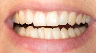 An up-close image of a person’s overcrowded teeth along the bottom row