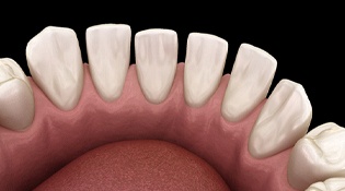 A digital image of a bottom arch of teeth that have gaps between them