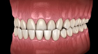 A digital image of the top row of teeth sitting inside the bottom teeth forming an underbite
