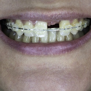 close up of woman with clear braces and missing front tooth
