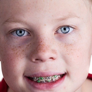 boy smiling wearing metal braces