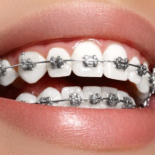Close up of smile with braces