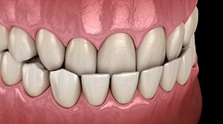 A digital image of an underbite where the lower teeth protrude out further and the top teeth sit inside the bottom arch