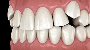 A digital image of crowded teeth located along the top arch of teeth