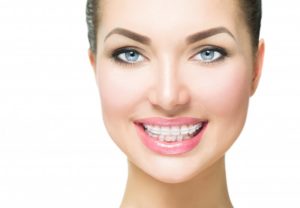 woman smiling wearing clear braces