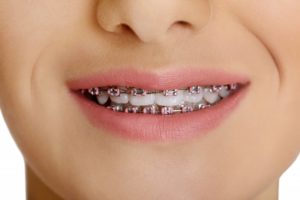 woman smiling with braces on teeth