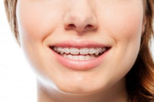 Metal or Clear Braces in Bethel Park Which Type is Better Metal or Clear Braces in Bethel Park Which Type is Better