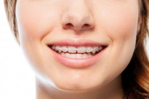  Metal  or Clear Braces in Bethel  Park Which Type is Better 