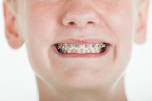 Closeup of boy smiling with braces